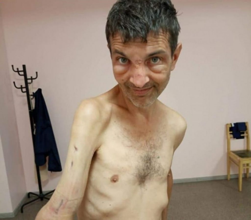 PHOTO.  The wounded Azov soldier whose photo went viral has had surgery and looks much better